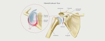 There are three main types of labrum tears: Shoulder Labral Tear Motus Physical Therapy