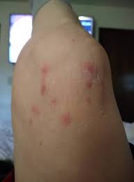 Image result for ant bite