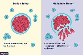 Differences Between A Malignant And Benign Tumor Malignant Tumor Tumor Lymph Nodes