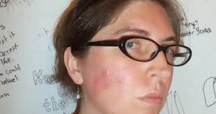 Poison Ivy On the Face