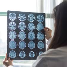 Ttfields attenuate mpm tumor progression in murine . Tumor Treating Fields Ttf As A Cancer Treatment