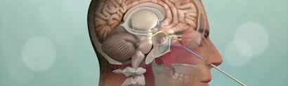 Minimally Invasive Brain Surgery | Keyhole Surgery | Pacific Brain Tumor  Center