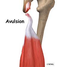 Also, nearly 1 in 3 hamstring injuries will recur and many of these happen within the first 2 weeks of returning to sport. Hamstring Injuries Eorthopod Com