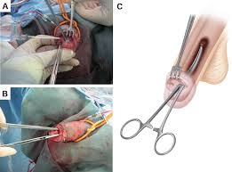 Image result for Priapism