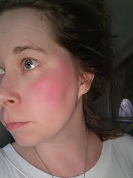 Elbow skin problems from planks and side planks?