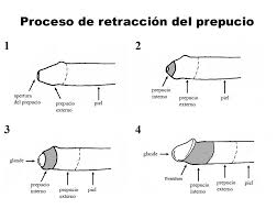 Fimosis Causas Sintomas Complicaciones Y Tratamiento Dr Auguet