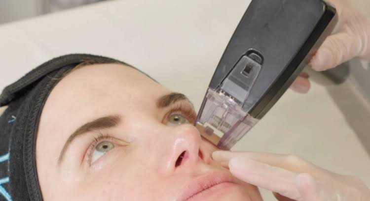 Morpheus8 Manchester | RF Microneedling | CLNQ Clinic
