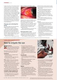 Image result for Eye Irrigation