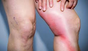 Sie birgt die gefahr einer lungenembolie und des postthrombotischen syndroms. La Thrombose Veineuse Phlebite Index Sante