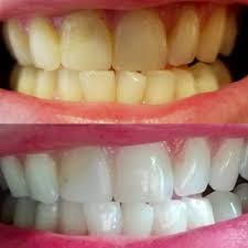 Brush your teeth regularly, drink water alongside your coffee; 20 Teeth Whiteners That Work So Well It S Like Magic