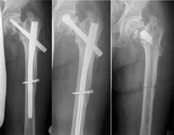 The PFNA® Augmented in Revision Surgery of Proximal Femur ...