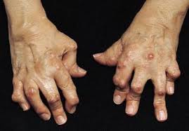 Rheumatoid arthritis (ra) is a chronic autoimmune disorder characterized by inflammation of the peripheral joints, leading to pain, stiffness, and joint damage and deformity over time. Rheumatoid Arthritis Ra Musculoskeletal And Connective Tissue Disorders Msd Manual Professional Edition