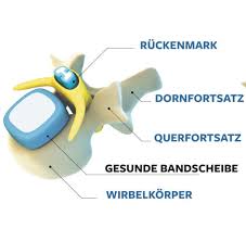 Ruckenschmerzen Wann Ein Bandscheibenvorfall Zum Notfall Wird Welt