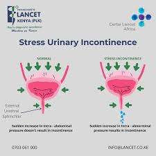 Image result for Stress Incontinence