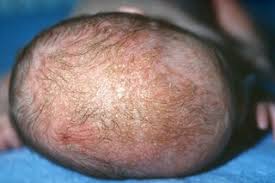 It's cradle cap, it's very common and normal for her age and no do not use pantene on your babies hair. Cradle Cap Nhs
