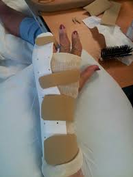 Image result for Ulnar Gutter Splint