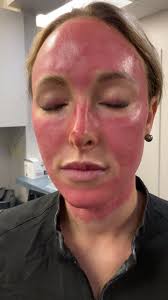 In this patient, Sami McCarty PA-C used a full syringe of Restylane via  cannula. These results were immediate and will likely get even better over  the next two weeks!!! #Restylane #teartroughfiller #topinjectorsatthebeach |