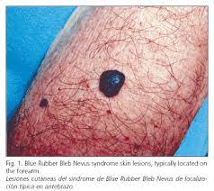 Sindrome De Blue Rubber Bled Nevus Tres Casos