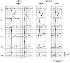 Image result for Electrocardiogram Validity