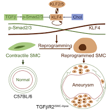 Smooth Muscle Cell Reprogramming in Aortic Aneurysms: Cell Stem Cell