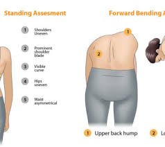 Image result for Risser Sign