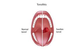 Image result for Tonsillitis