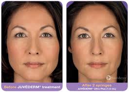 A nasolabial fold that is too deep can give your face a tired expression. Juvederm Torrance Facial Line Filling South Bay Cheek Volume Los Angeles Long Beach