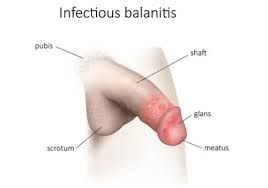 Image result for balanoposthitis