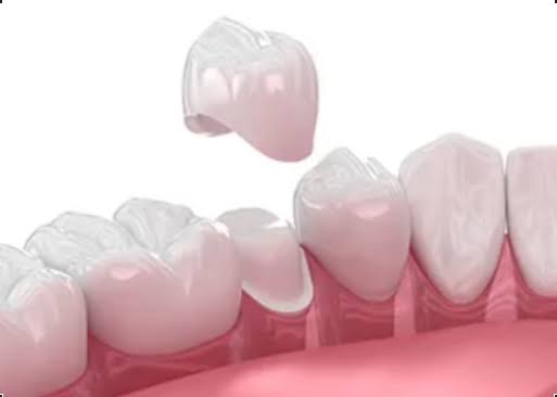 Dental Crowns product image