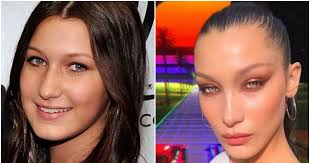 Before And After Bella Hadid S Plastic Surgery And Ever Changing Face