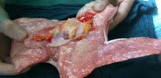 In der lunge befindet sich ein netzwerk aus bronchien (= feinen röhrchen), die. Gpp Transplantation