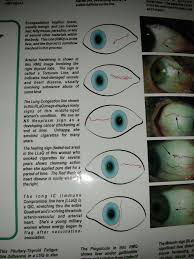 Iridology Chart Left Eye Unique 16 Best Sclerology Images On