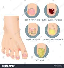 Image result for Yellow nail syndrome feet