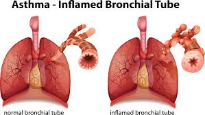 It is characterized by variable and recurring symptoms, reversible airflow obstruction, and easily triggered bronchospasms. Understanding Asthma Asthma Canada
