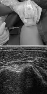 Image result for Biceps Tendon Injection
