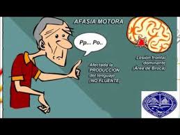 Afasia de broca (motora) lugar de la lesión: Afasia De Broca Universidad Autonoma De Santo Domingo Uasd Youtube