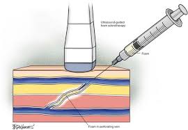 Sotradecol sclerotherapy appears to be a useful adjunct to the therapeutic arsenal for orbital to describe the results of intralesional injection of the sclerosing agent sodium tetradecyl sulfate in. Chemical Ablation Clinical Gate
