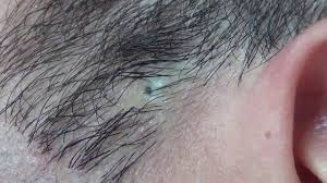 (visited 578 times, 1 visits today) acne treatment blackhead blackheads how to pop a pimple how to remove blackheads huge blackheads pimple pimple popper pimple popping popahol. Pin On Curly Hair Styles
