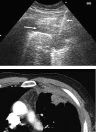 A mesothelioma diagnosis is officially made through a biopsy. Analysis Of Dry Mesothelioma With Ultrasound Guided Biopsies Lung Cancer