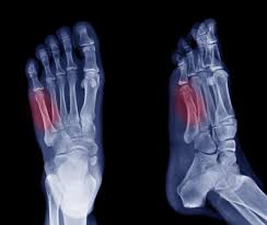 Specific types of metatarsal fracture include an avulsion fracture, where the tendon of the peroneus brevis muscle pulls a piece of the bone away. Jones Fracture Causes Symptoms And Treatment