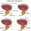 Explains prostate problems including prostatitis and benign prostatic hyperplasia. 1