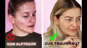 Pickelmale sind aber nicht gleich pickelmale, es wird nämlich zwischen pie (roten pickelmalen) und pih (braunen pickelmalen). In Nur 3 Monaten Zur Traumhaut Heftiges Ergebnis Microneedling Vorher Nachher Diana Delo Youtube
