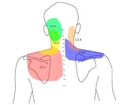 Resultado de imagem para artrose cervical