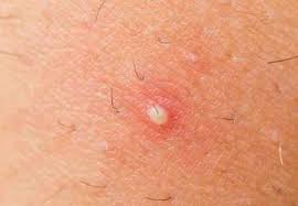 Pimples on the chin are no different to pimples on other parts of the face, neck, chest, and back. Pin On Ideas For The House