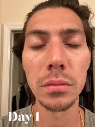 I had good amount of healthy hair before covid but I think due to anxiety  ND stress I lost almost half of my hair.. It's Healthy bt became thin now ,  kichu