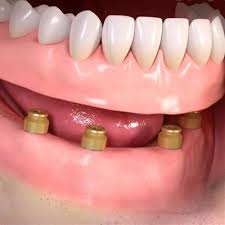 Gaps left by missing teeth can cause problems with eating and speech, and teeth either side of the gap may grow into the space at an angle. Fixed Dentures Implant Supported Dental Suite Hounslow