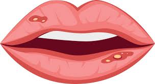 Image result for Lip Cancer