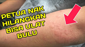 Garam mampu menghilangkan kotoran yang melekat di kulit kepala karena keringat serta dan mengatasi ketombe yang menjadi pemicu gatal di kepala. Petua Nak Hilangkan Bisa Ulat Bulu Gatal Gatal Youtube