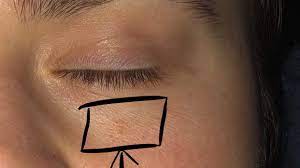 The strongest risk factor for developing skin cancer is ultraviolet (uv) ray exposure, typically from the sun. The Spot Under This Woman S Eye Looked Like A Pimple But It Was Skin Cancer Health Com