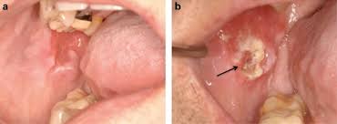 Image result for spinocellular carcinoma of the oral cavity